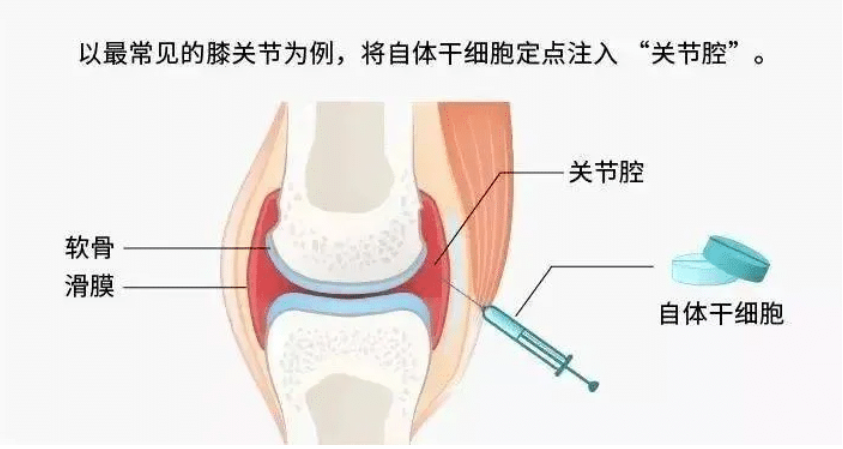 PRP、干细胞、外泌体傻傻分不清？揭秘再生医学“三巨头”，谁才是膝盖的救命稻草？